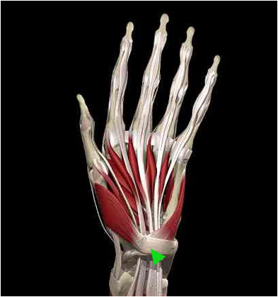 Tendons In Hand. One of the most common hand